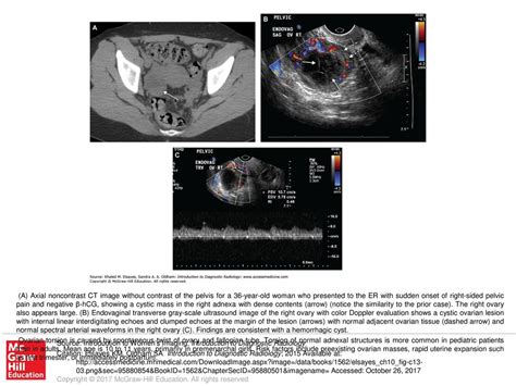 diagnostic test for ovarian torsion|ovarian torsion precautions patient education.